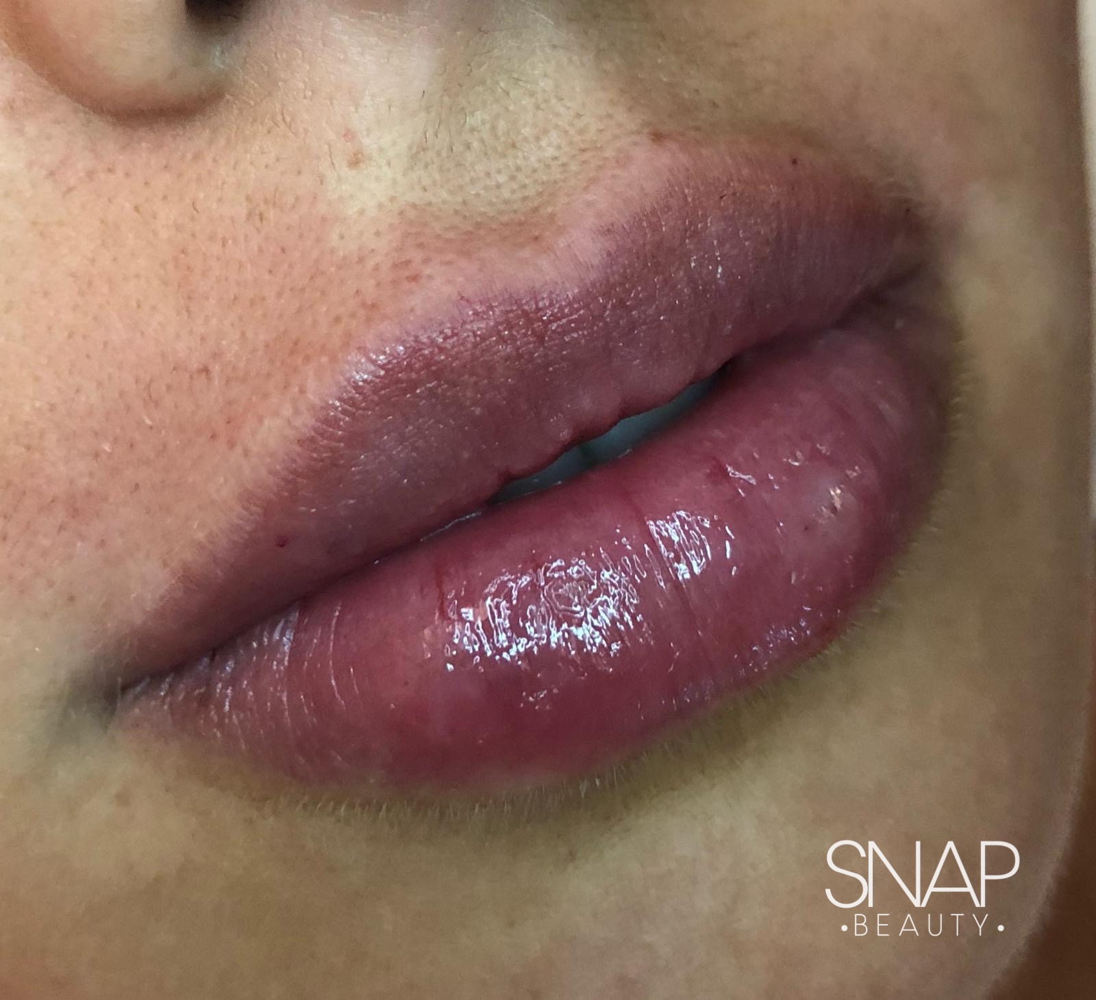 lip fillers southend