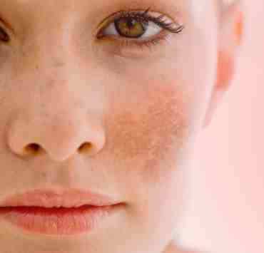 Pigmentation – all you need to know!