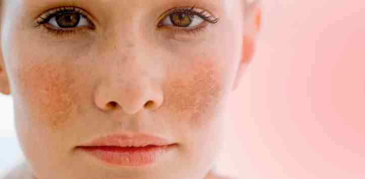 Pigmentation – all you need to know!