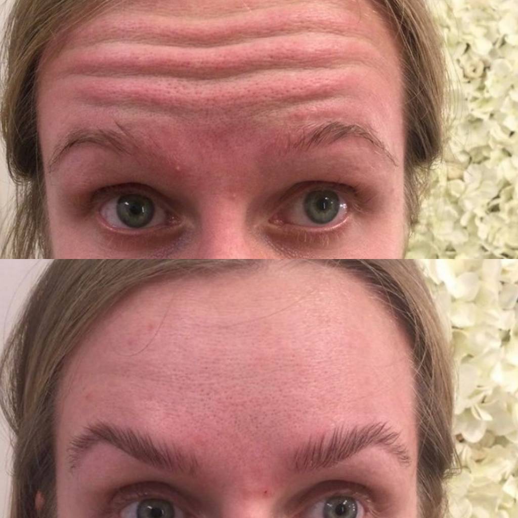 Botox southend on sea