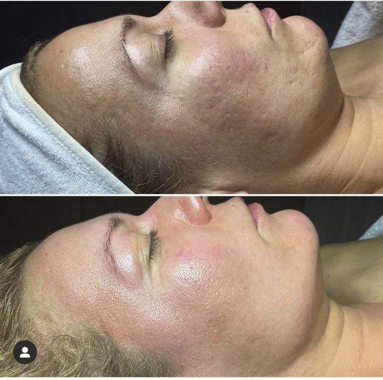 microneedling southend